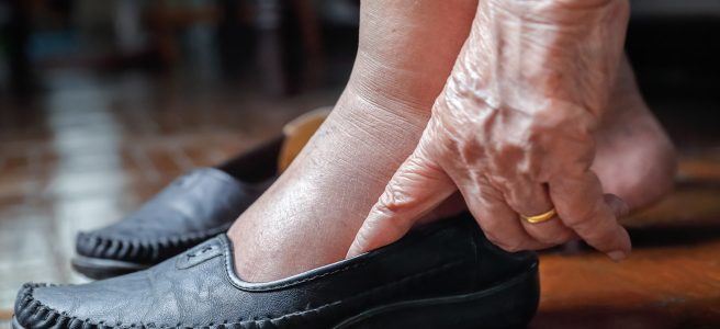 An old woman with swollen feet puts on a pair of house shoes.